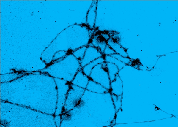 Nanotecnología. Alzheimer: La memoria del olvido